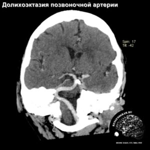 other_angio_head_MRI_2