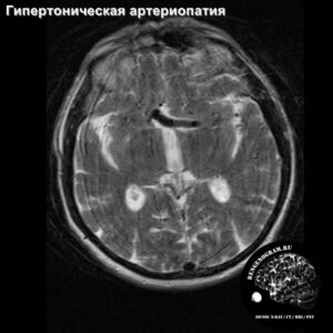 other_angio_head_MRI_3