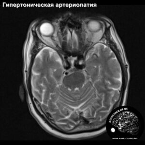 other_angio_head_MRI_4