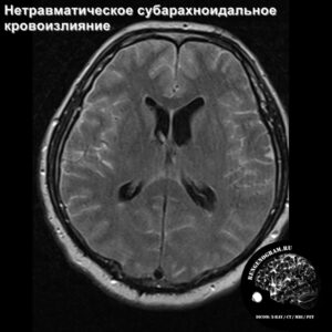 other_angio_head_MRI_5