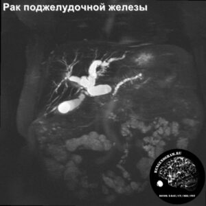 pancreas_tumor_mri_cholangio
