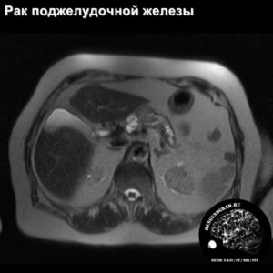 pancreas_tumor_mri_t2_tra