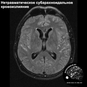 sah_head_MRI_1