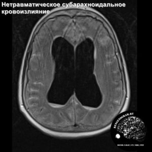 sah_head_MRI_2