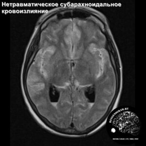 sah_head_MRI_3