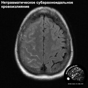 sah_head_MRI_4