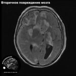 secondary_neuronal_injury_head_MRI_1