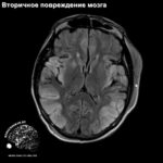 secondary_neuronal_injury_head_MRI_2