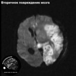 secondary_neuronal_injury_head_MRI_3