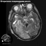 secondary_neuronal_injury_head_MRI_4