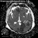 secondary_neuronal_injury_head_MRI_5