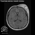 soft_tissue_trauma_head_MRI_2
