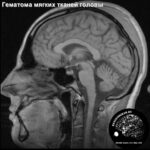 soft_tissue_trauma_head_MRI_3