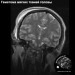 soft_tissue_trauma_head_MRI_4