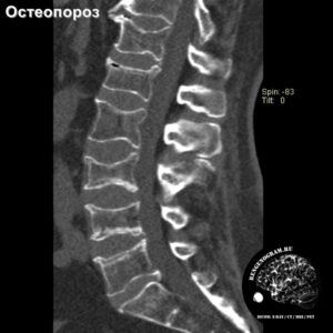 spine_mrtabolic_ct_osteoporosis_sag