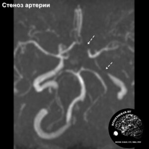 stenosis_head_MRI_1