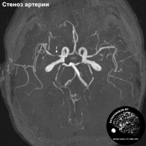 stenosis_head_MRI_3