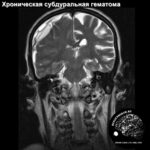 subdural_haed_MRI_3