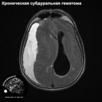 subdural_haed_MRI_4