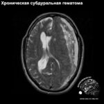 subdural_haed_MRI_5