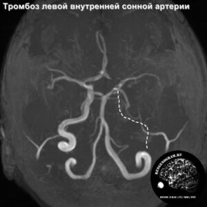 thrombosis_head_MRI_2