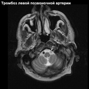 thrombosis_head_MRI_5