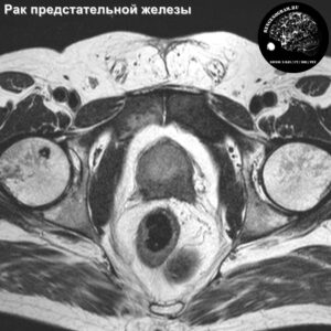 typical_prostate_carcinoma_mts_mri_t2_tra