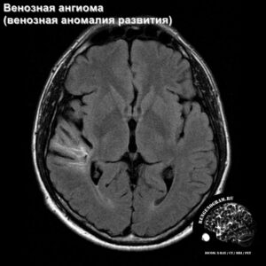 venous_angioma_head_MRI_1