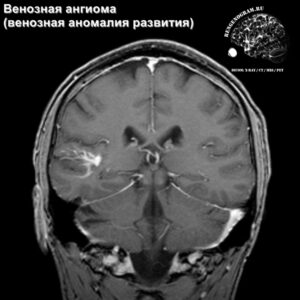 venous_angioma_head_MRI_2