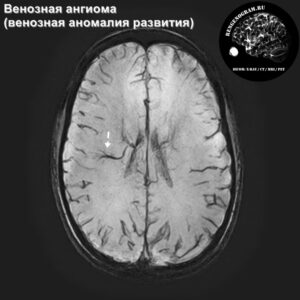 venous_angioma_head_MRI_3