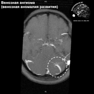 venous_angioma_head_MRI_4