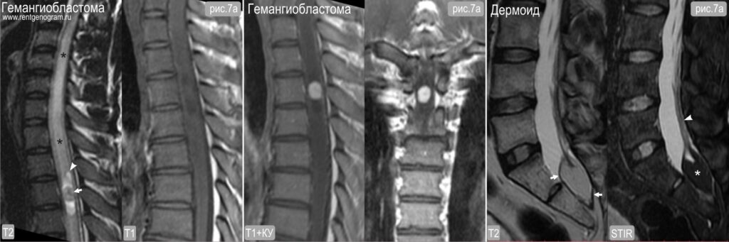 7_spine_hemangioblastoma_mri